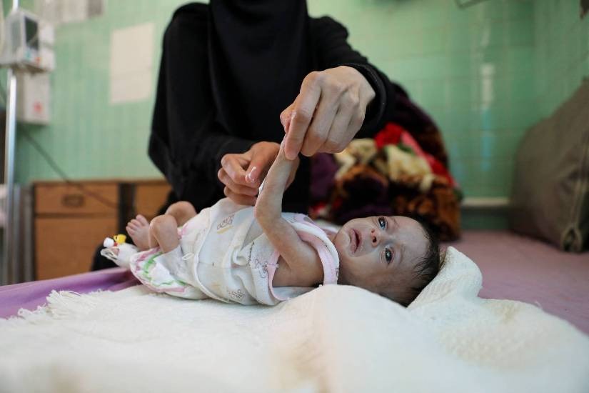 Yemen's Malnutrition Crisis Worsens: Western Coast Sees Critical Levels, UN Report Warns