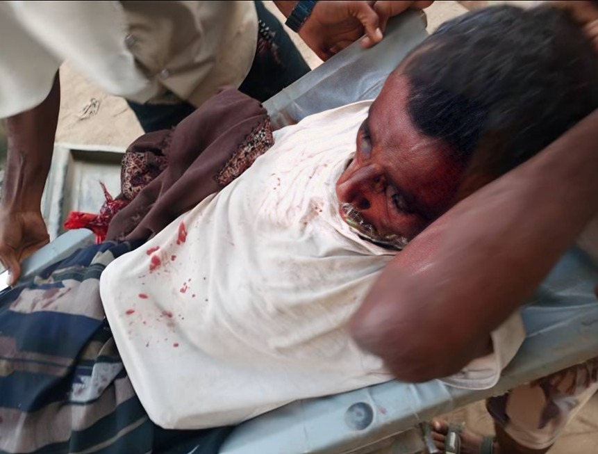 Local Man Injured by Houthi Mortar Shelling in Southern Hodeida