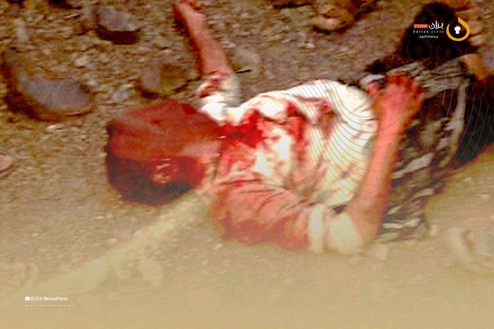 Child Critically Injured by Houthi Landmine in Western Taiz Child Critically Injured by Houthi Landmine in Western Taiz
