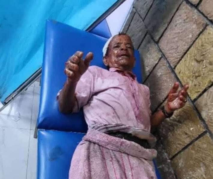 Yemeni Elderly Vendor in Ibb Burned by Houthi Supervisor
