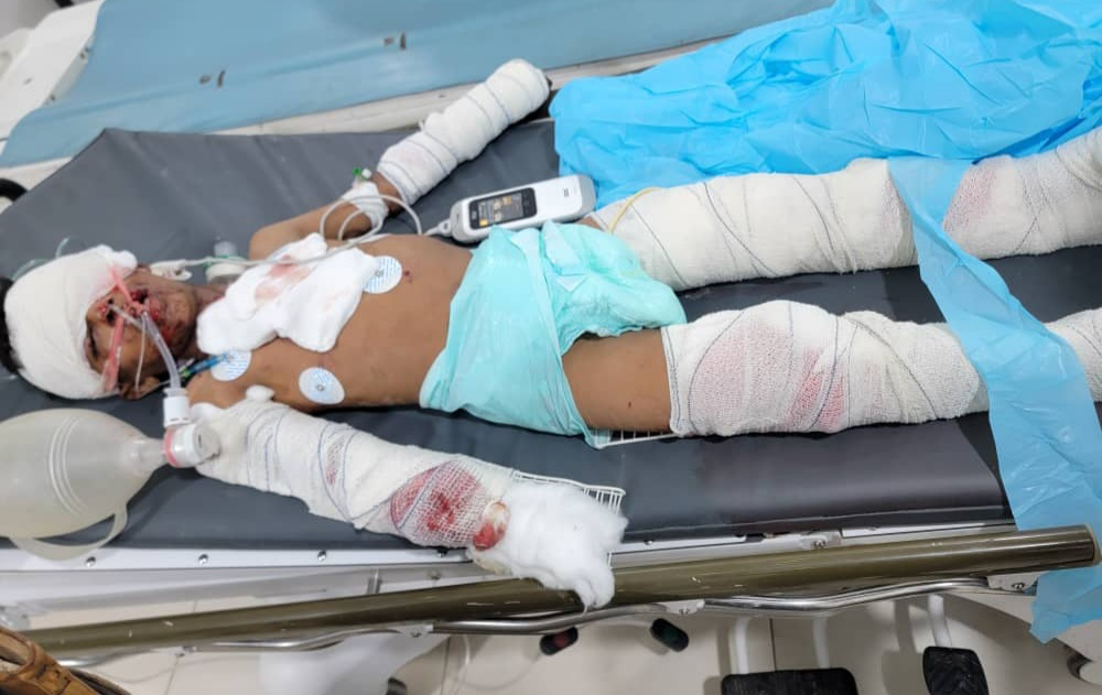 Children Severely Injured by War Remnant in Marib