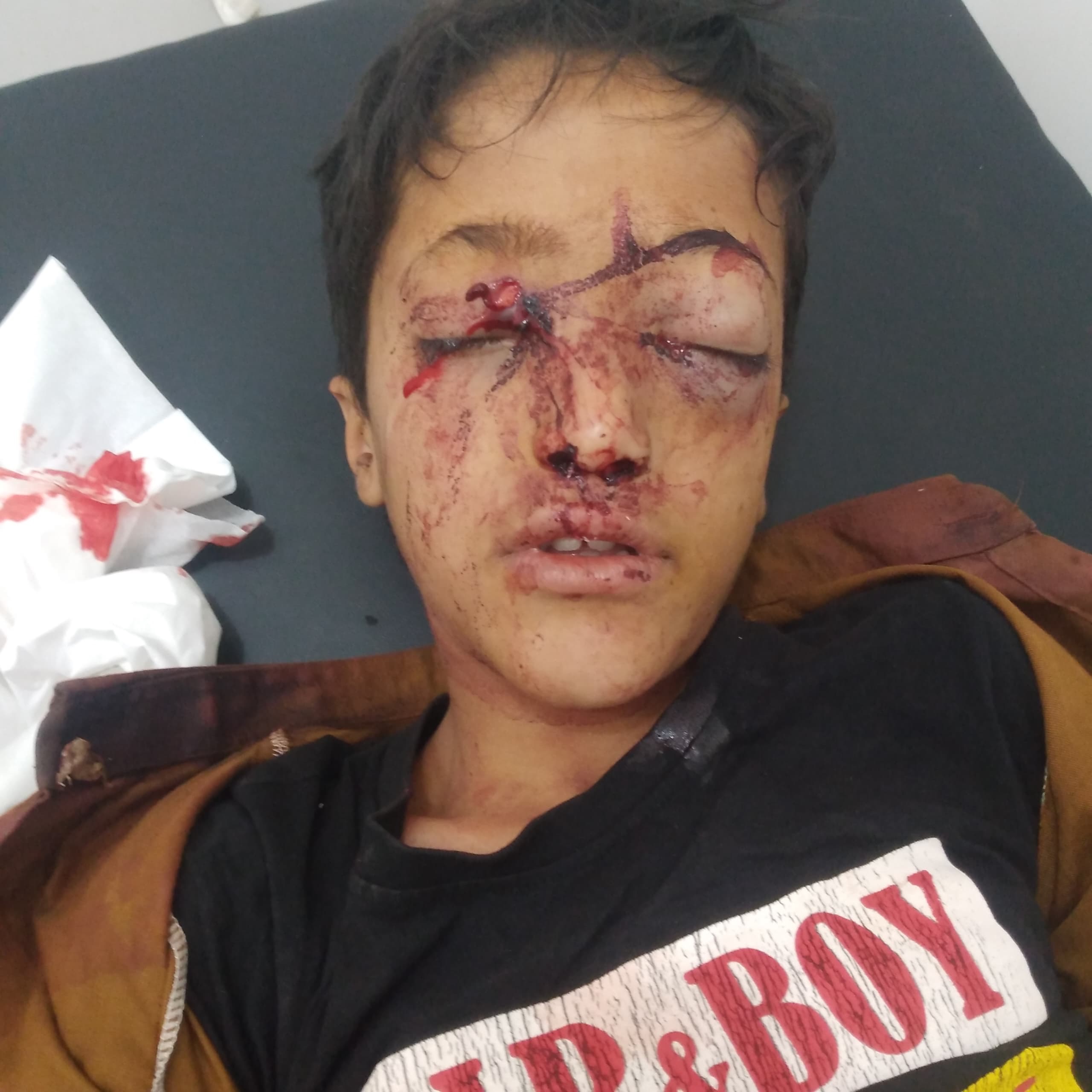 Child Shot in Tal-Shaqab, Houthi Sniper Victim Tally Rises to 279 in Taiz